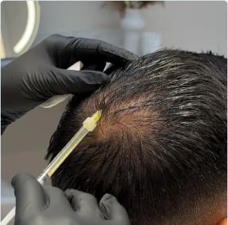 PRP Platelet-Rich Plasma hair treatment being applied