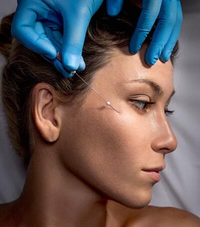 PDO thread lift needle being inserted near the brow and temple